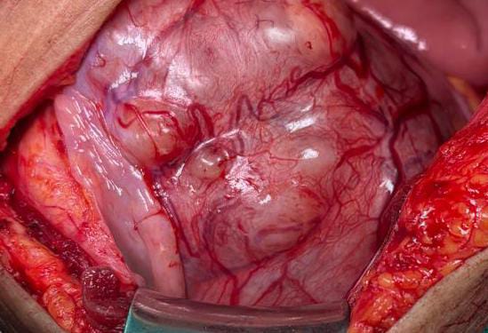 Uterine Leiomyosarcoma?(LMS)