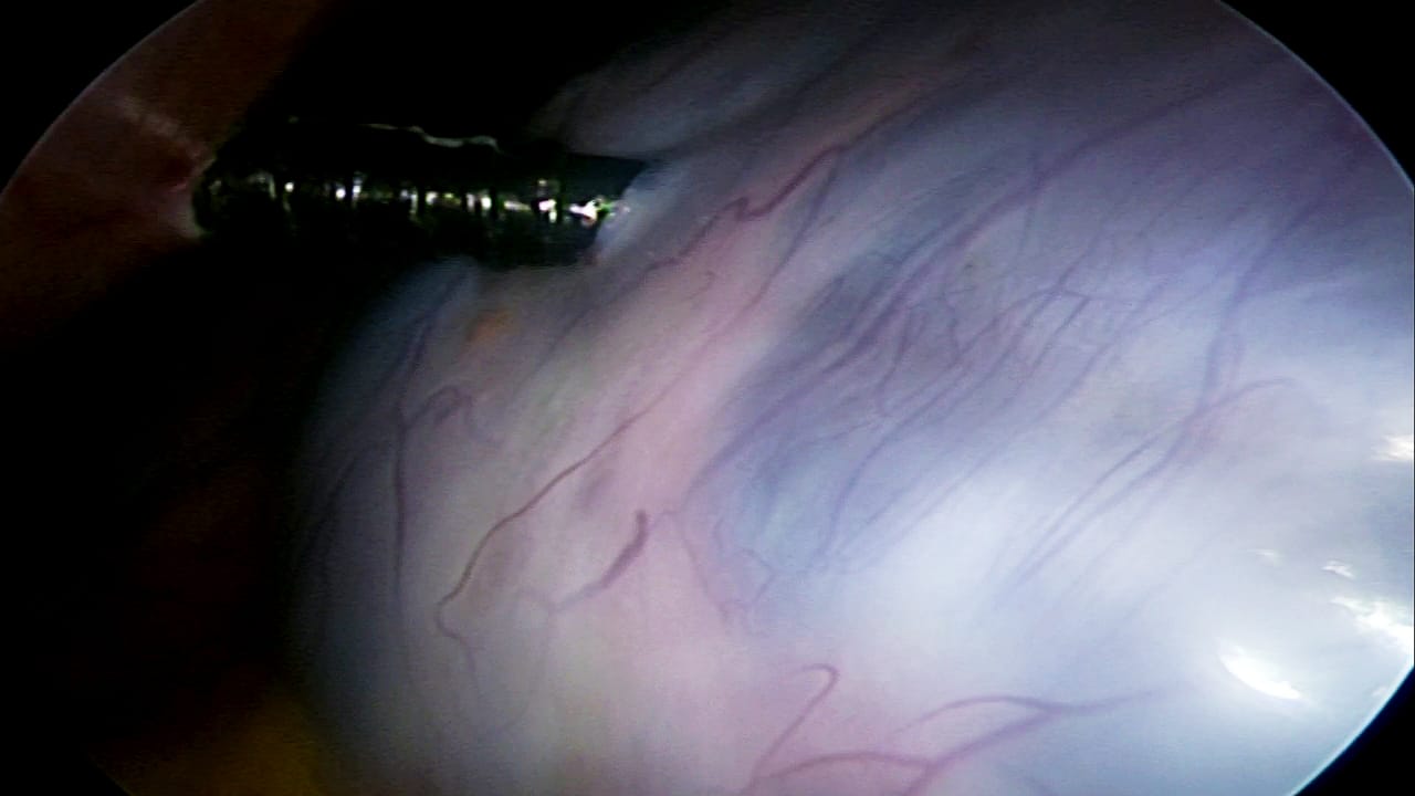 Large Abdominal Lump