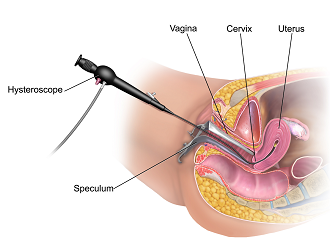 Service-Hysteroscopy