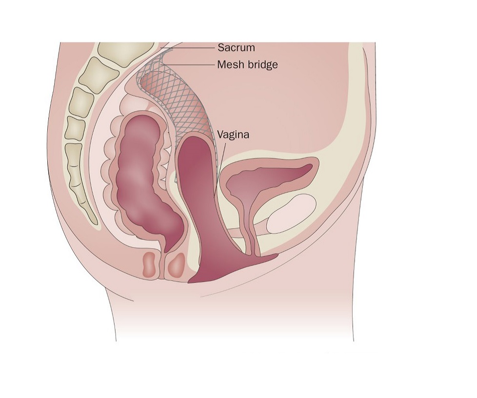 Laparoscopic Prolapse Repair in Nashik