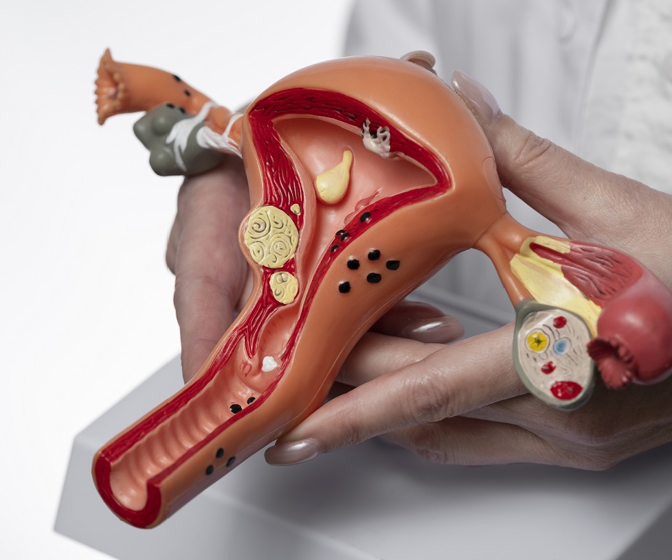 Ovarian Tumor Laparoscopy in Nashik