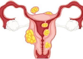 Service-Lap Myomectomy